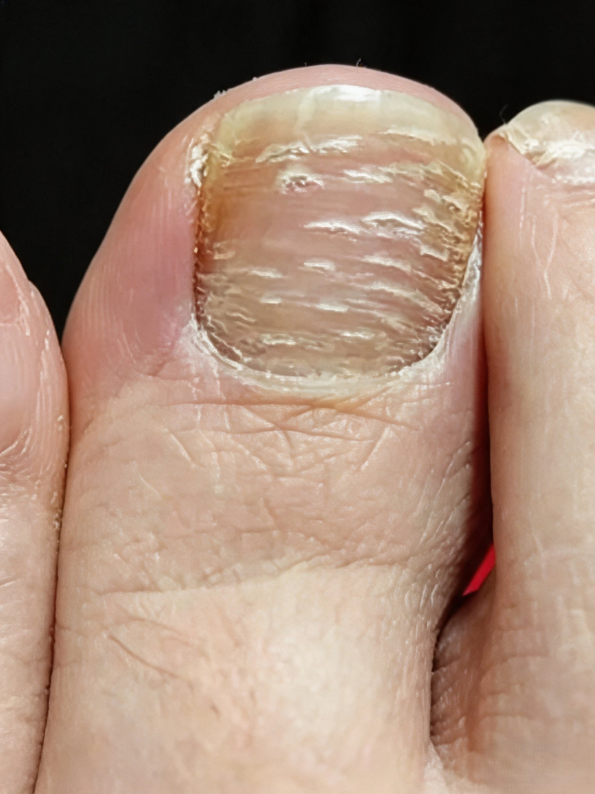 Brittle & Textured Nails